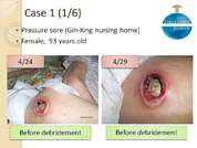 Algi-White (Alginate non-woven): for pressure ulcer 